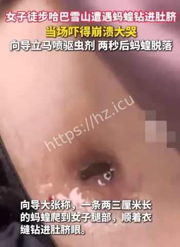 女子惨遇蚂蝗钻肚脐